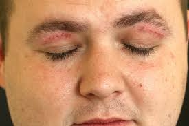 Northern Ireland man has 'whata boutye' eyelid tatoo removed year