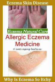 Eczema Solutions The Eczema Diet Amazon Is Eczema Considered A Fungus Pictures Of People With Eczema Images Of Eczema On El Eczema Eczema Treatment Eczema Cure