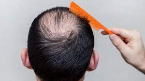 Money expert clark howard got a call from chuck, 43, who began researching various products and needed. Cheap Hair Loss Treatment A Threat To The Hair Dermaclinix