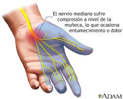 Sindrome Del Tunel Carpiano Medlineplus Enciclopedia Medica