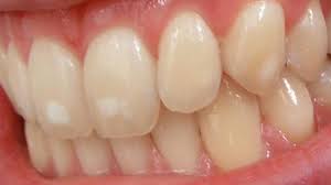 Brushing and flossing is the. White Spots On Teeth 11 Tips On How To Get Rid Of Them
