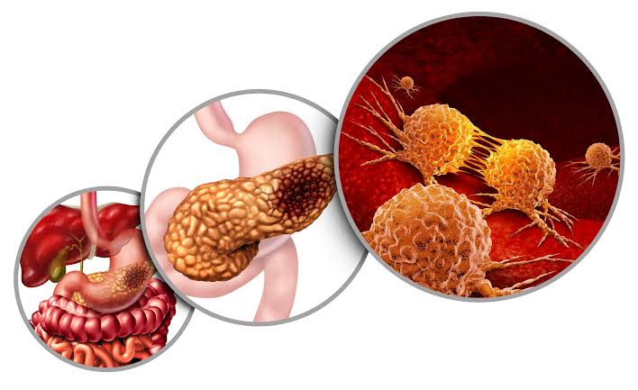 Pancreatic Cancer: Essential Information & Insights