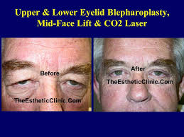 , that can achieve brilliant results. Face Lift Surgery Mumbai Best Face Lifting Treatment Cost India The Esthetic Clinics