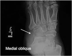 Avulsion fractures can be confused with other types of fractures to the fifth metatarsal bone. Avulsion Fractures In The Foot Telltale Radiographic Signs To Avoid Mismanagement Sciencedirect