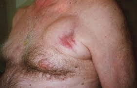 Like a pacemaker, an implantable cardioverter defibrillator, or icd, is a device placed under your skin. How To Treat And Identify Device Infections Heart Rhythm