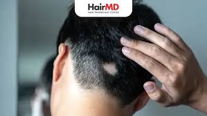 Image result for Alopecia