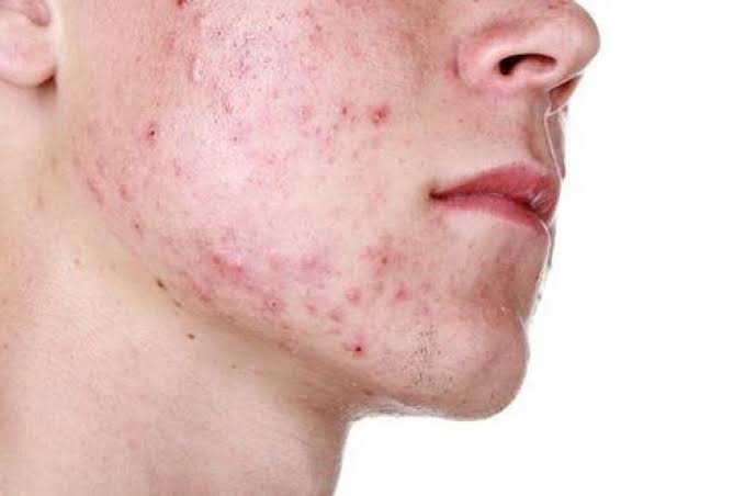 Resultado de imagen para acne en la piel"