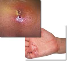 It is a type of staphylococcus aureus bacterium. Mrsa City Of Eau Claire Wisconsin