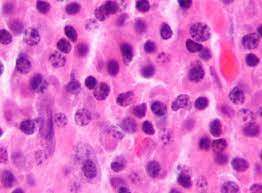 A type of cancer that begins in plasma cells (white blood cells that produce antibodies). Multiple Myeloma Wikipedia