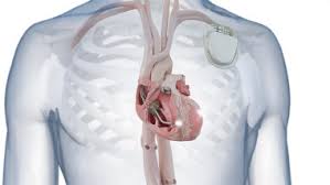 Image result for Cardiac Resynchronization Therapy