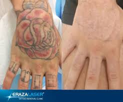 Mix 100 gm of salt in lemon juice and dip a cotton ball in this mixture. Tattoo Removal Training Theory Erazalaser College