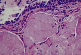 Same patient as in figures 2 and 3, showing conjunctiva with acellular eosinophilic deposits in. Histologic Appearance Of Amyloid Growths Upon Congo Red Staining Download Scientific Diagram