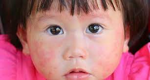 Penicillin Allergy Think Again Science News