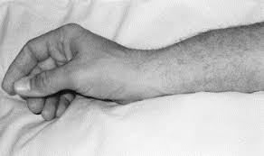 Image result for Intersection Syndrome