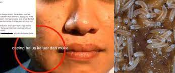 Manfaat daun pandan cukup beragam bagi kesehatan. Saya Buat Rawatan Guna Daun Pandan Dan Limau Nipis Ulat Semua Keluar Jangan Percaya Pada Mitos Resdung Bukan Ulat