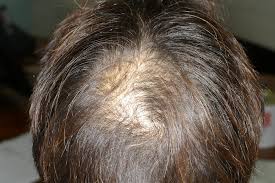 Heureusement, il est possible de trouver un traitement contre la chute des cheveux survenant chez une femme, à condition auparavant d'en. Dermato Info L Alopecie
