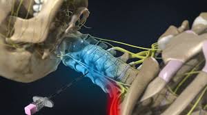 Image result for Lower Cervical Intramuscular Injection