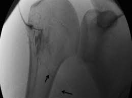 Image result for Biceps Tendon Injection
