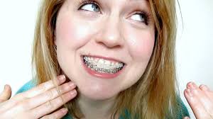 When deciding whether or not to go ahead with getting braces it is important to assess whether you 'need' braces in order to help manage dental problems associated with misaligned teeth or whether you want braces. Why I Decided To Get Braces Again Qtt Youtube