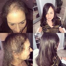 With some conditions, such as patchy hair loss (alopecia areata), hair may regrow without treatment within a year. Pin By Victor Sepulveda On Masajes Doterra Chemotherapy Hair Loss Chemo Hair Loss Hair Loss Solutions