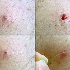 Image result for chancroid