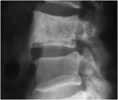 The spine is a darker white than the background, and shows all of the intricate details of the various parts from the top to the bottom. Paget S Disease Chapter 9 Pathology Of Bone And Joint Disorders