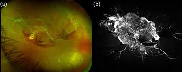 Rhegmatogenous retinal detachment with horseshoe tear. Proliferative Diabetic Retinopathy A Optos Color Fundus Slo Of Left Download Scientific Diagram