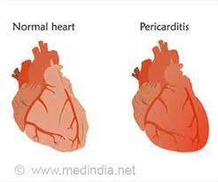 This fluid keeps the layers from rubbing as the heart moves to pump blood. Pericarditis Causes Symptoms And Signs Diagnosis Treatment
