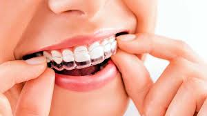 Clear Aligner Therapy | Smile Centre India
