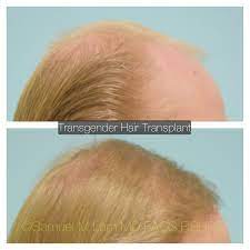 Pin On Transgender Hair Transplant