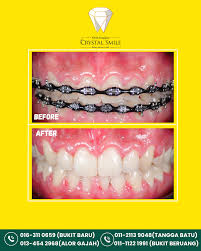 KLINIK PERGIGIAN CRYSTAL SMILE, BUKIT BARU MELAKA (Klinik gigi terbaik - Braces, Implan, Whitening)