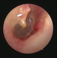 Image result for Ossicular Chain Disruption
