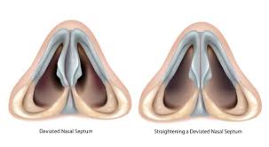 Deviated nasal septum DNS treatment
