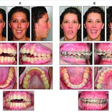 Pdf Recurrence Of The Anterior Open Bite After Orthognathic Surgery 3d Analysis Of Dental Soft Tissue Skeletal And Airway Changes In Unravelling The Aetiology Of Relapse