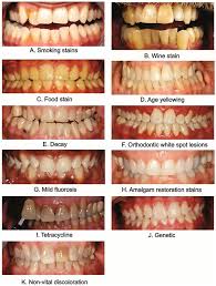 In fact, there are several different ways to naturally whiten your teeth at home without breaking the bank or buying anything with plastic packaging. How To Whiten Teeth Naturally Home Treatment Vs Professional Therapy
