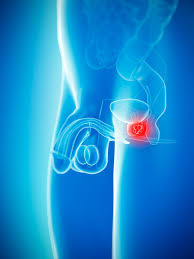 See your doctor if you have symptoms. What Does The Prostate Do Can You Live Without It And What Happens When You Have It Removed