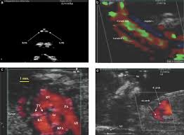 Between 11 weeks and 13 weeks plus six days of pregnancy or when your baby measures between 45mm and 84mm, crown to rump Fetal Echocardiography At The Time Of The Nuchal Translucency Scan Lombardi 2007 Ultrasound In Obstetrics Amp Gynecology Wiley Online Library