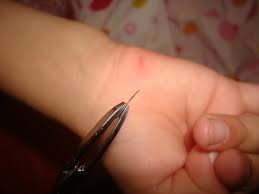 Below are the 5 best and least traumatic ways to remove a splinter in a complaining child: Splinter Sliver Removal Doctor Rennie S Blog