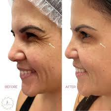 ✨ Transform your look with our Botox before and after results at Facial  Mania Med Spa! Say hello to smoother, younger-looking skin and goodbye to  wrinkles. Plus, take advantage of our unbeatable