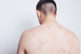 Kolesterol yang merupakan salah satu penyebab penyakit jantung juga dapat diturunkan dengan mengkonsumsi wortel secara teratur. Ini Penyebab Jerawat Di Punggung Dan 7 Cara Ampuh Menghilangkannya Lifebuoy Indonesia