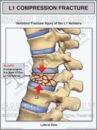 Apr 25, 2018 · a burst fracture is a more serious condition compared to compression and wedge fractures. Pin On Stock Medical Exhibits
