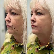 Anatomy first. Artistry always ✨ Press play to get anti-wrinkle injections  and to come behind the scenes with Dr Grace at this patient's appointment  👩🏼‍⚕️⏯️💉 No two faces are the same -