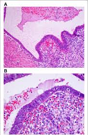 a, b Typical histopathological images of the wall of endometrioma...
