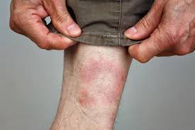 Image result for infected tick bite
