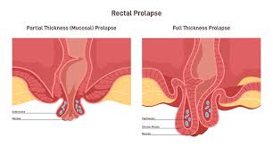 Image result for Rectal prolapse