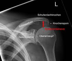 Impingement Syndrom Schulter