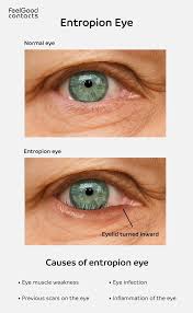 Image result for Entropion