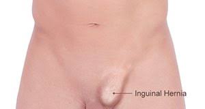 Designed by e corbould, lithograph by f howard. Legends Of Surgery V Twitter Weird Old Medical Term Of The Day Bubonocele It Means A Groin Hernia And Comes From The Ancient Greek BoubÅn Meaning Swelling In The Groin Same Root