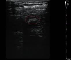 Glücklicherweise sind die meisten fälle von verstopfung bei kindern vorübergehend. Ursachen Und Symptome Von Hartem Stuhl Und Kotsteinen Fekalom
