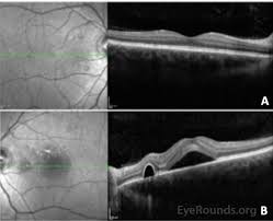 We did not find results for: Central Serous Chorioretinopathy